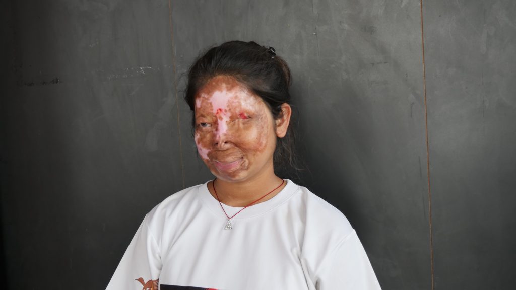 Urvasi Xxxx Video - Anshu: Finding the lost identity after acid attack | The Stories Of Change