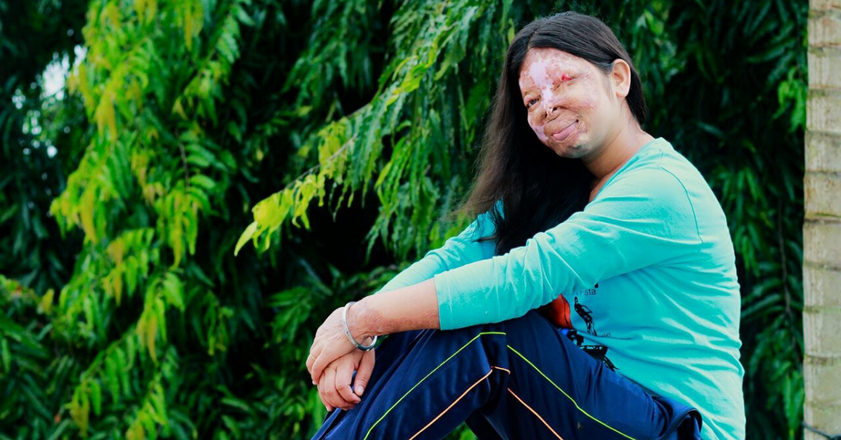 Anshu: Finding the lost identity after acid attack